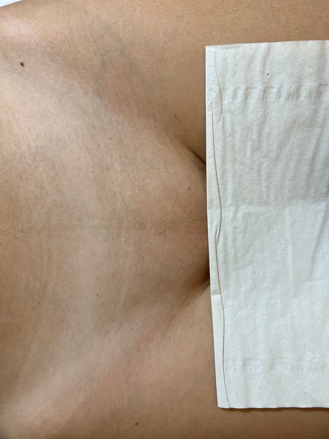 The same area after a course of laser hair removal - clearer skin
