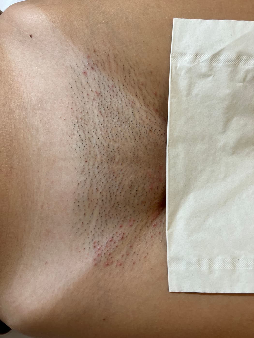 Area before laser hair removal - hair visible
