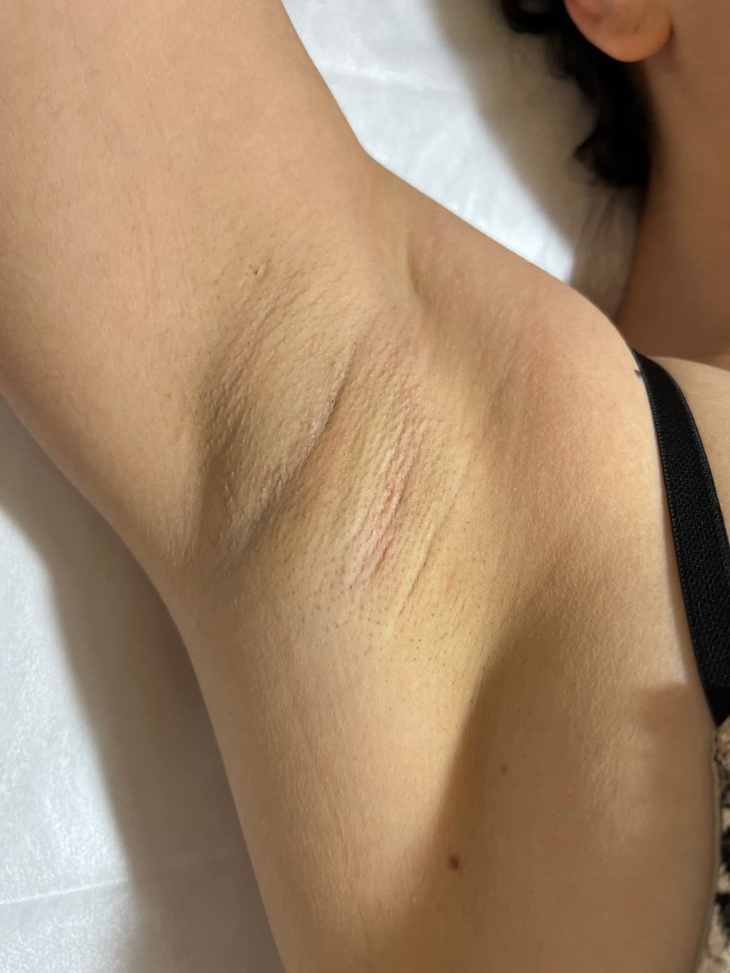 The same area after a course of laser hair removal - clearer skin