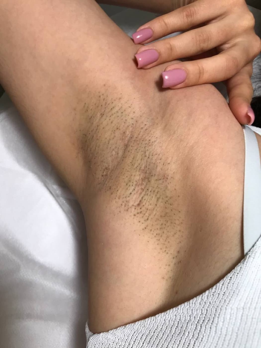 Area before laser hair removal - hair visible